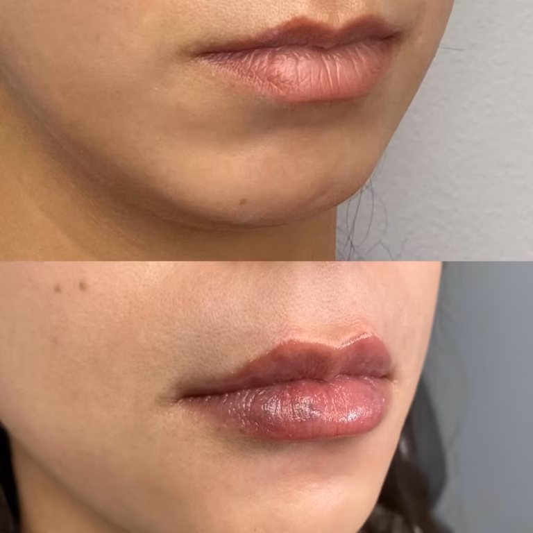 Juvederm Lips Fillers patient #400 before and after