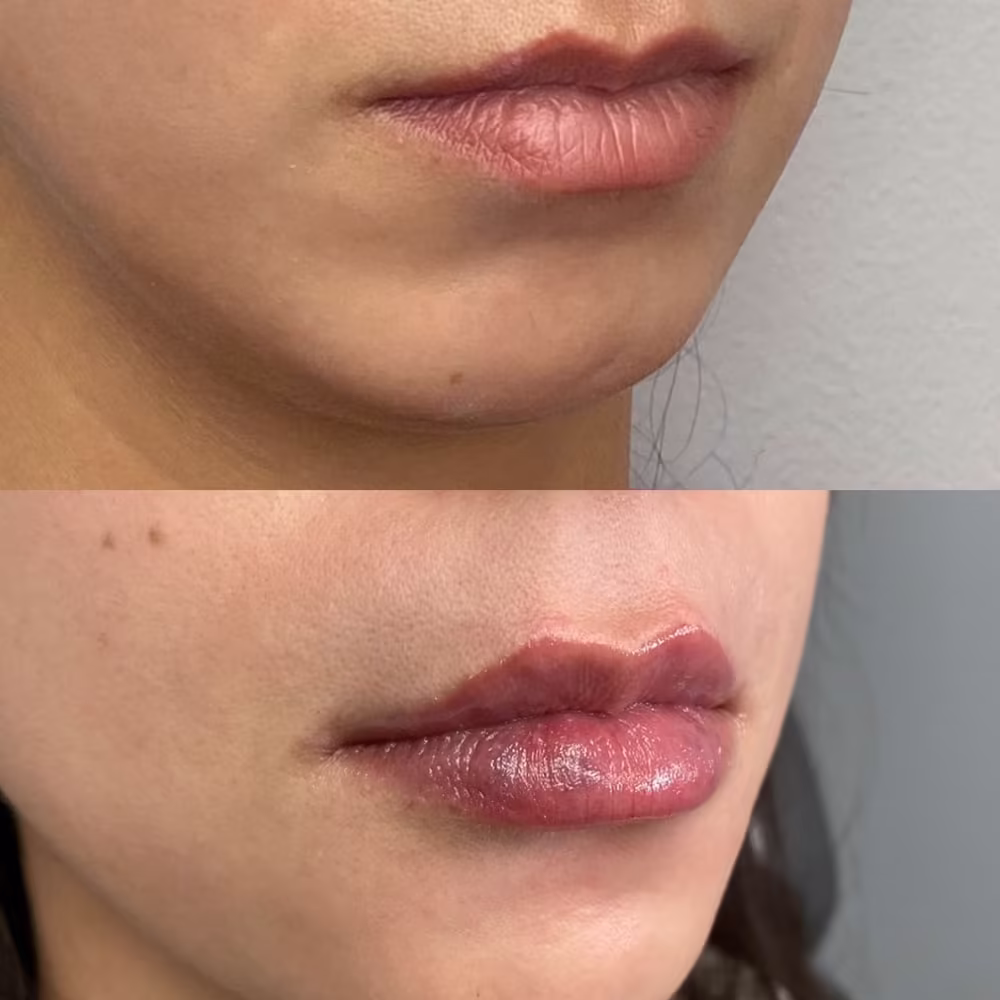 Profile view before and after dermal filler injection adding lip projection and volume in Scottsdale