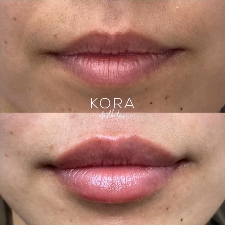 Juvederm Lips Fillers patient #394 before and after