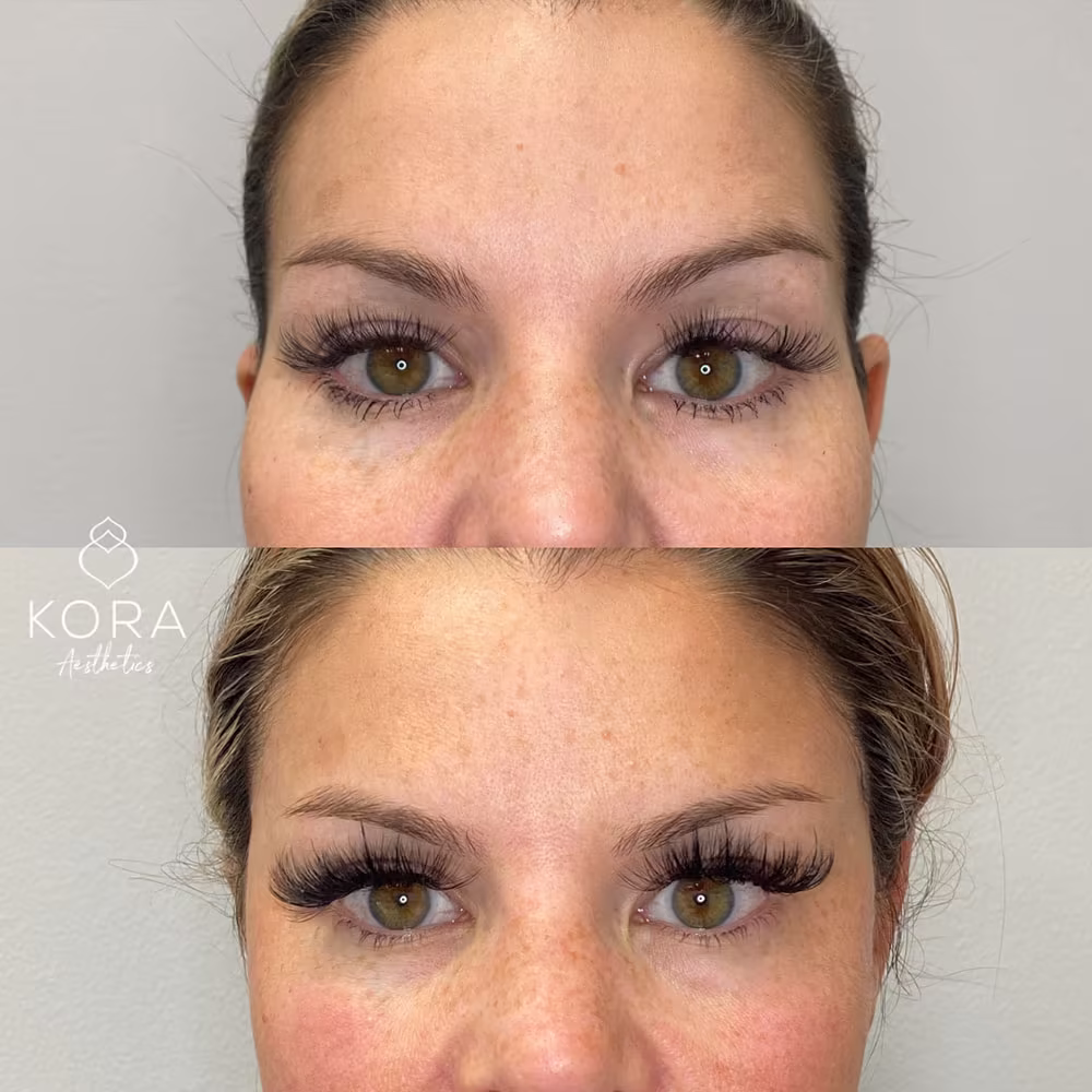 Frontal view before and after comparison of upper face temple filler injections in Scottsdale
