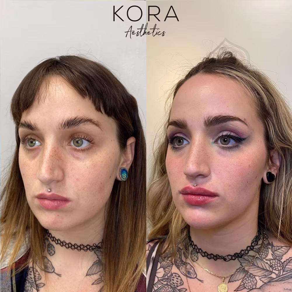 Three-quarter view before and after under eye filler and lip volume restoration in Scottsdale