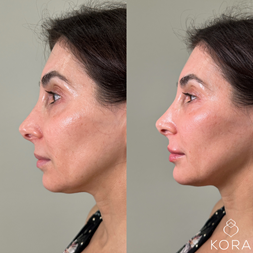 Side profile before and after filler treatment showing enhanced lips and improved chin projection for a more balanced facial profile in Scottsdale
