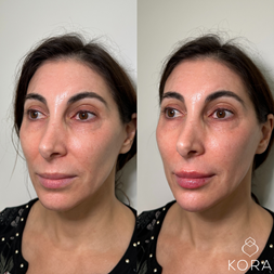 Before and after three-quarter facial view showing fuller lips, improved facial balance, and soft profile enhancement with filler in Scottsdale