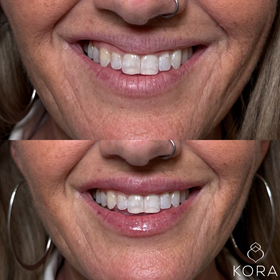Close-up before and after lip hydrate treatment showing improved lip smoothness, upper lip visibility, and smile balance in Scottsdale