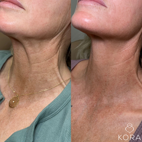 Before and after neck Botox treatment showing reduced vertical platysmal bands and smoother neck skin in Scottsdale