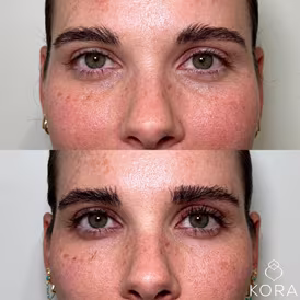 Before and after PRF under-eye treatment showing reduced discoloration and improved skin quality beneath the eyes in Scottsdale
