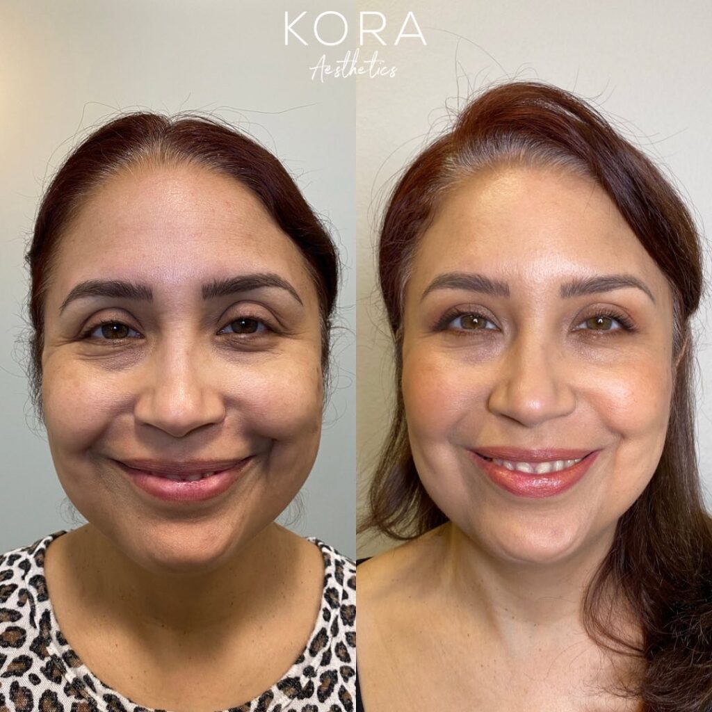 Before and after comparison showing smoothed crow's feet and reduced fine lines around the eyes in Scottsdale