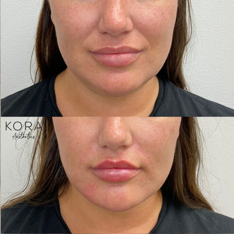 Dermal Filler Smile Lines patient #348 before and after