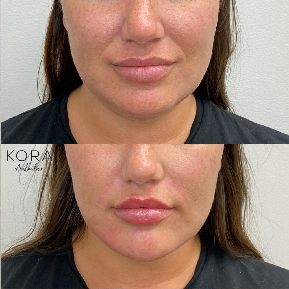 Close-up before and after view showing dermal filler smoothing smile lines around the mouth and restoring lip volume in Scottsdale